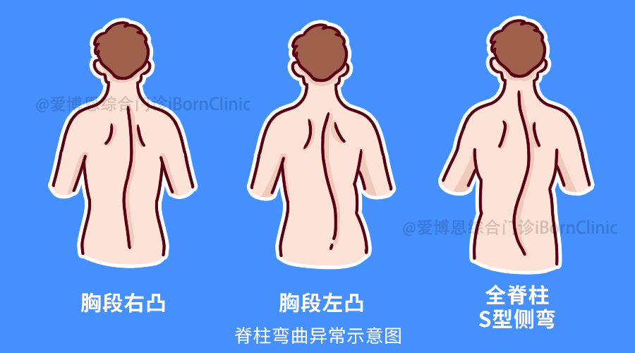 你的孩子是否有脊柱侧弯?教你如何自我筛查!